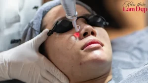 Shynh Perfect Treatment Là Gì? Chi Tiết Về Công Nghệ Điều Trị Lỗ Chân Lông To