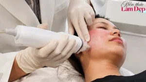 Công Nghệ Vi Kim RF Potenza: Giải Pháp Điều Trị Sẹo, Trẻ Hóa Da Bậc Nhất
